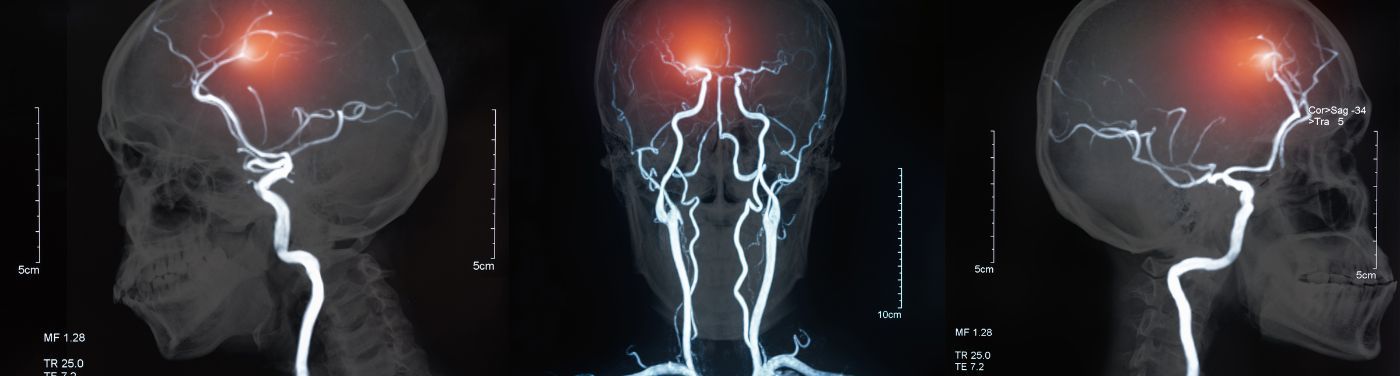 AVC hemorrágico: causas, sintomas e tratamentos disponíveis