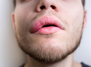 Angioedema 