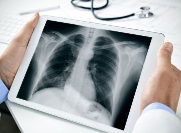 Câncer de pulmão mobile