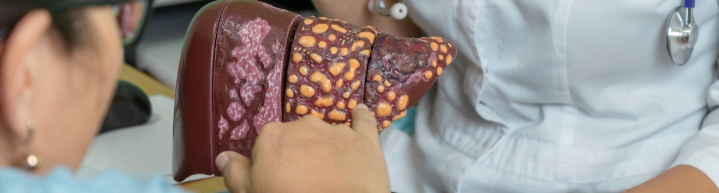 Cirrose hepática: entenda o que é e quais são os sintomas e o tratamento