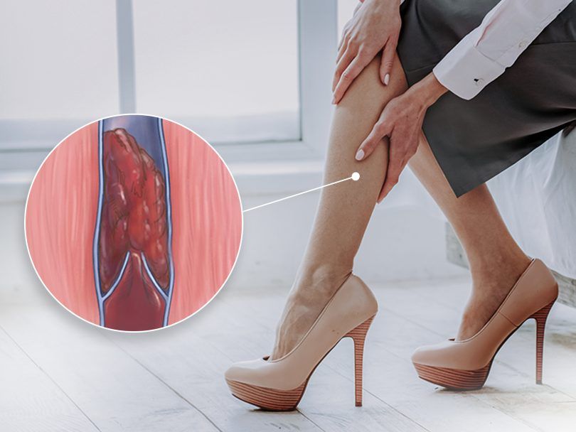 Ficar muito tempo parado pode causar trombose venosa