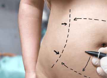 Cirurgia abdominal: quando é indicada e como funciona a preparação
