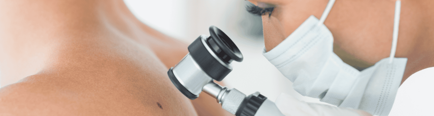 Carcinoma de células escamosas da pele: entenda o que é, causas e sintomas