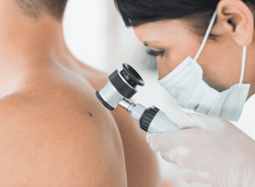 Carcinoma de células escamosas da pele: entenda o que é, causas e sintomas