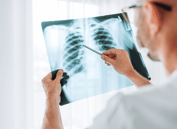 Nódulo no pulmão: causas, tipos e tratamento