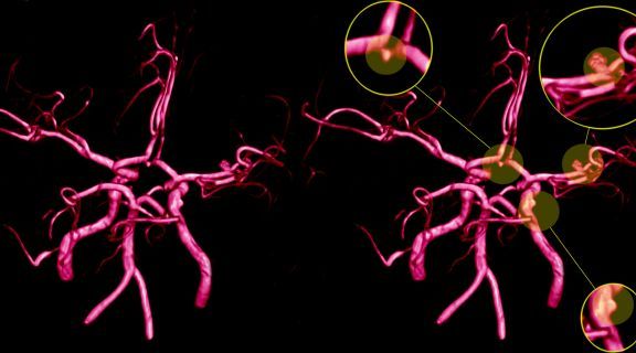 aneurisma-cerebral-causas