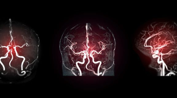 aneurisma cerebral sintomas iniciais