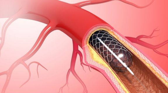 angioplastia transluminal percutâne