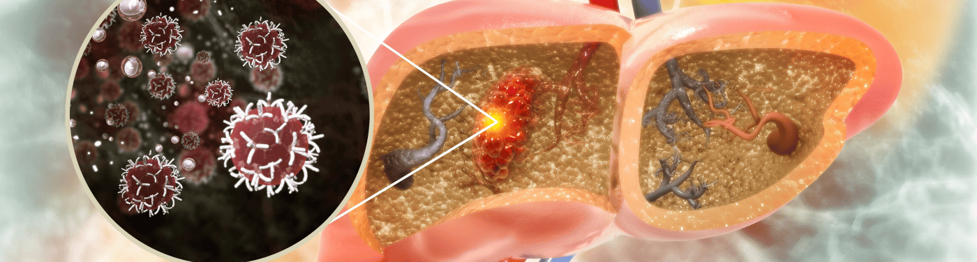 Saiba como prevenir o câncer de fígado