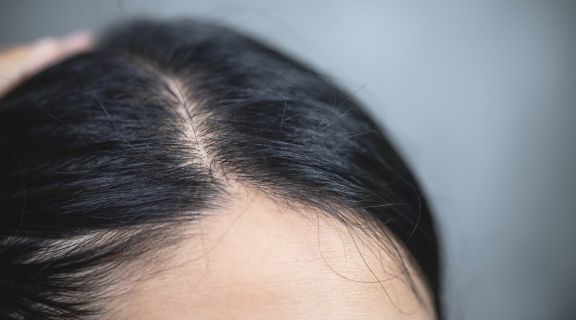 caspa faz o cabelo cair