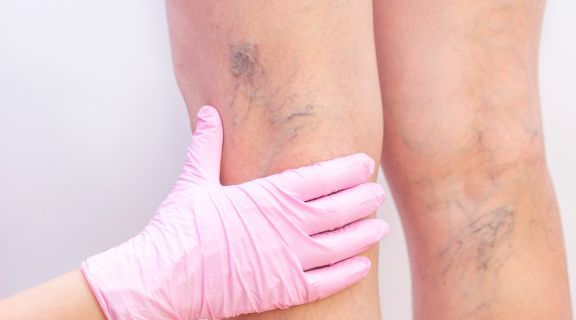 como fica a perna apos cirurgia de varizes