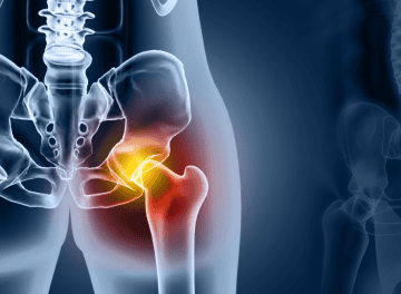 fratura de femur