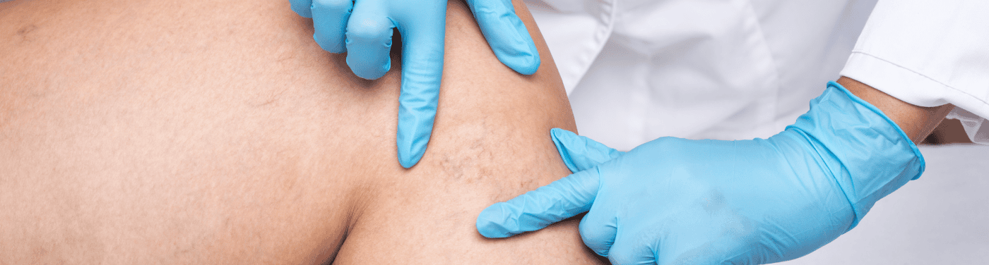 insuficiencia venosa cronica