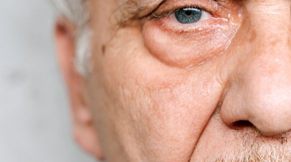 olho lacrimejando após cirurgia de catarata.jpg