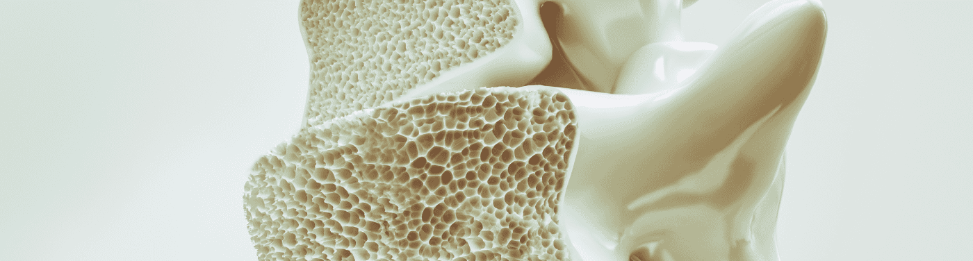 Osteoporose: causas, sintomas e tratamentos