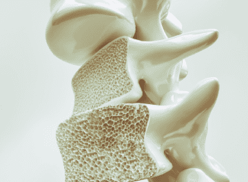 Osteoporose