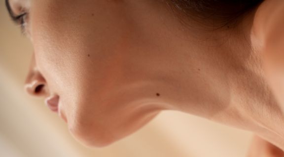 pinta de nascença pode virar melanoma_.jpg