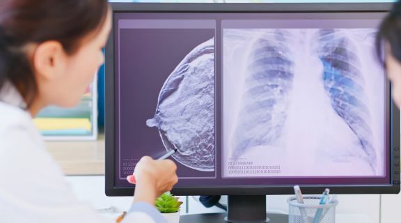 quais os primeiros sintomas de câncer de mama​