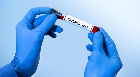 qual exame detecta cirrose alcoólica