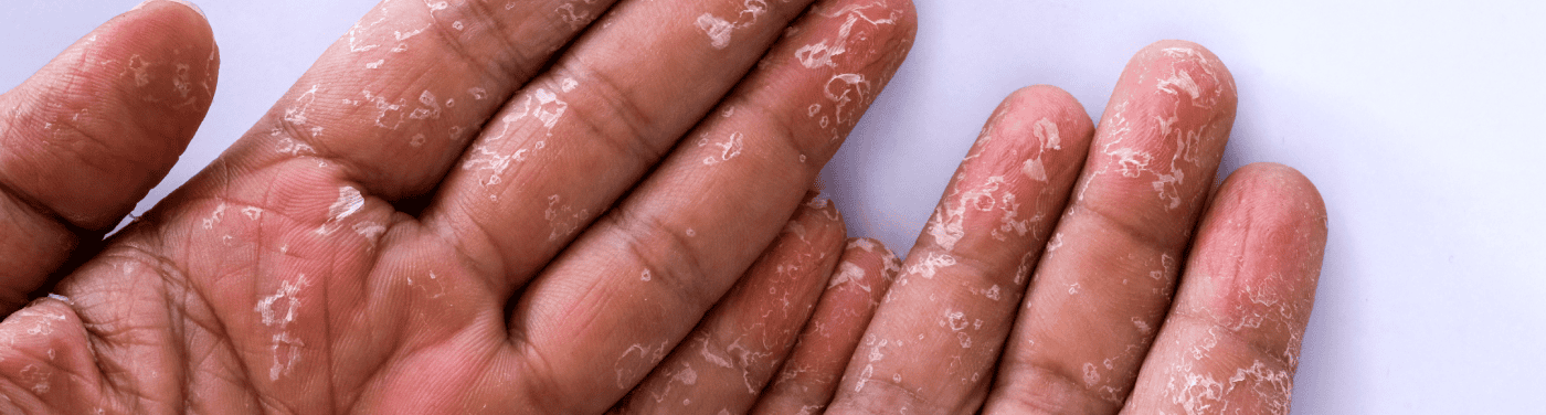 sindrome do choque toxico