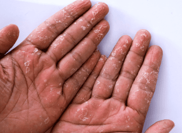 sindrome do choque toxico