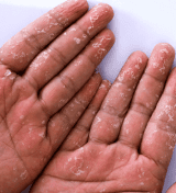 sindrome do choque toxico