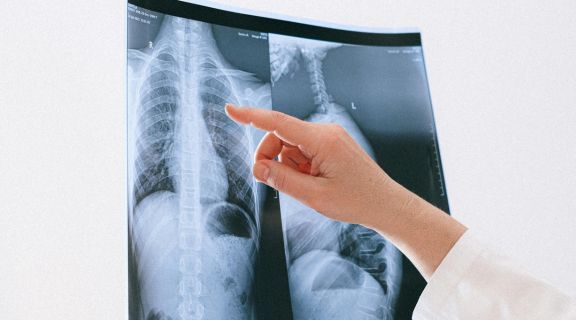 síndrome do desconforto respiratório agudo.jpg