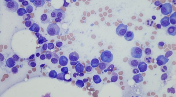 transplante de medula óssea em criança​