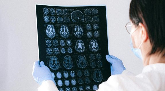 tratamento para esclerose múltipla.jpg