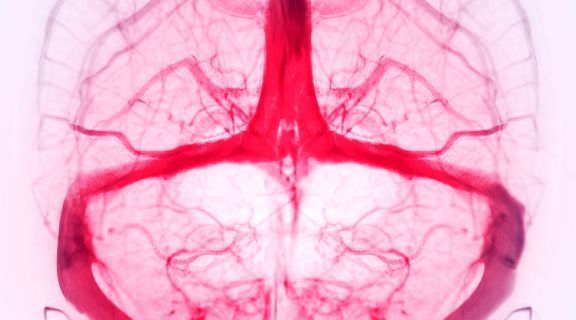 trombose venosa cerebral sintomas
