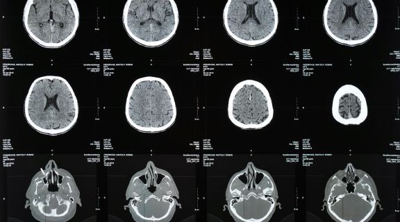trombose venosa cerebral sintomas.jpg