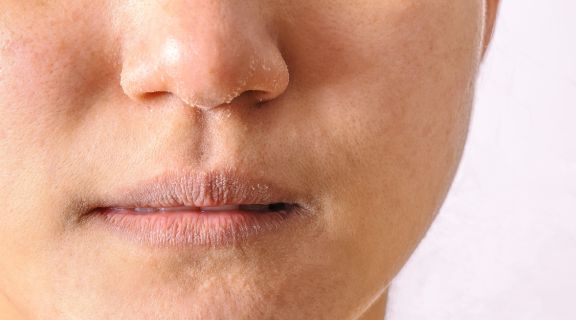 Câncer de pele no nariz: como identificar e agir