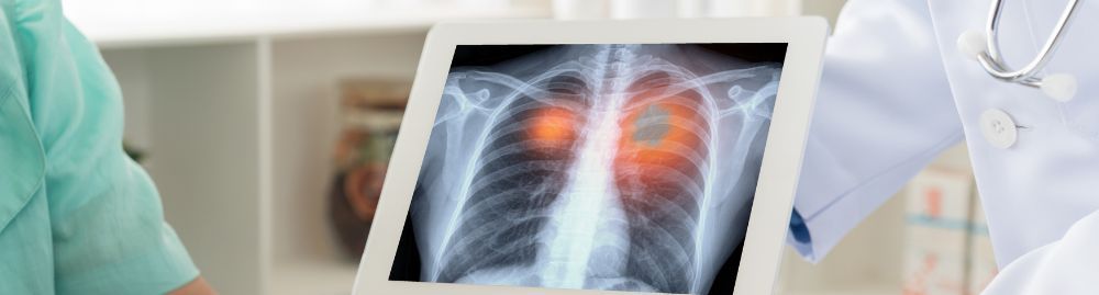 Câncer no pulmão1.jpg