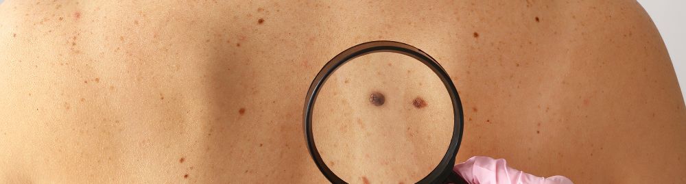 Como prevenir o câncer de pele1.jpg