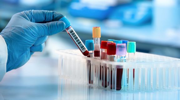 O que o exame de sangue para detectar câncer mostra?