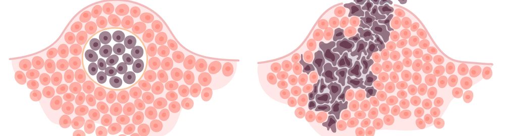Qual a diferença de câncer maligno e benigno1.jpg