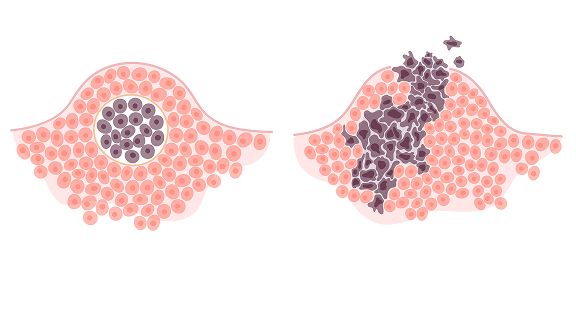 Qual a diferença de câncer maligno e benigno? Veja as principais características