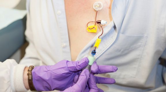 Efeitos da primeira sessão de quimioterapia: o que esperar