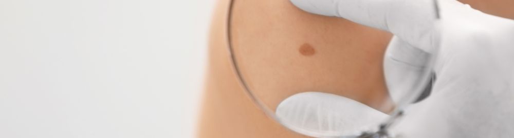 Tumores benignos de pele1.jpg