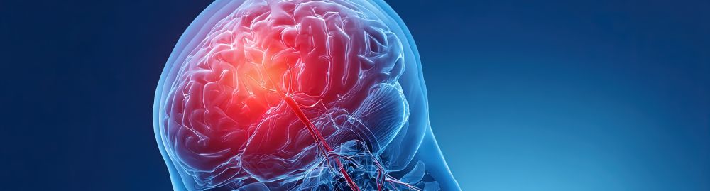 acidente vascular cerebral isquêmico_1.jpg