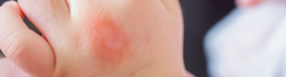 alergia na pele do bebê_1.jpg