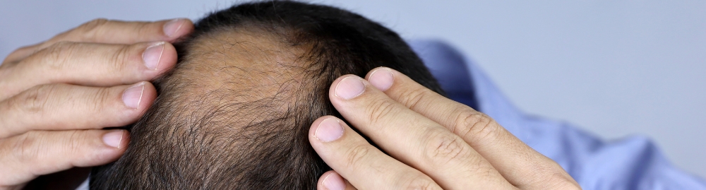 alopecia androgenética tratamento1.jpg