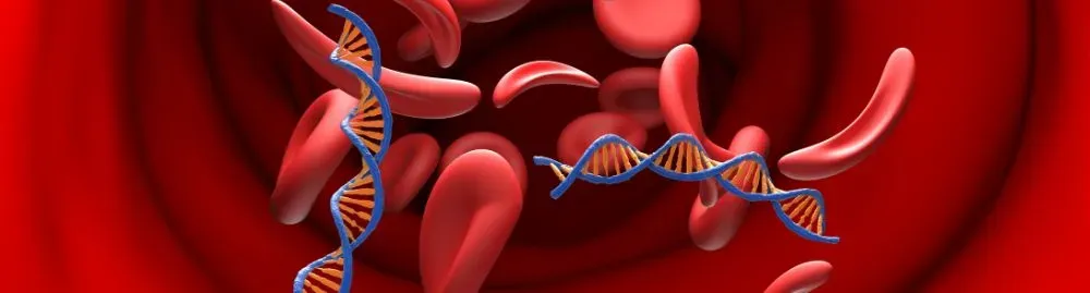 anemia falciforme é grave1.webp