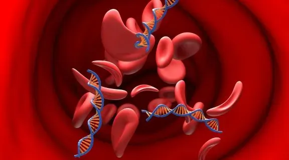 Anemia falciforme é grave? Entenda os riscos e os tratamentos