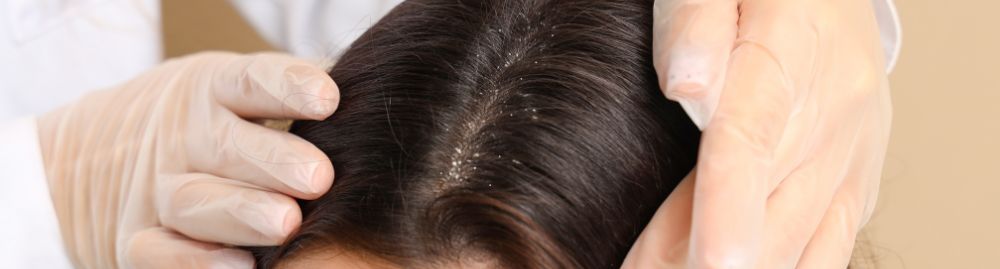 ansiedade causa caspa1.jpg