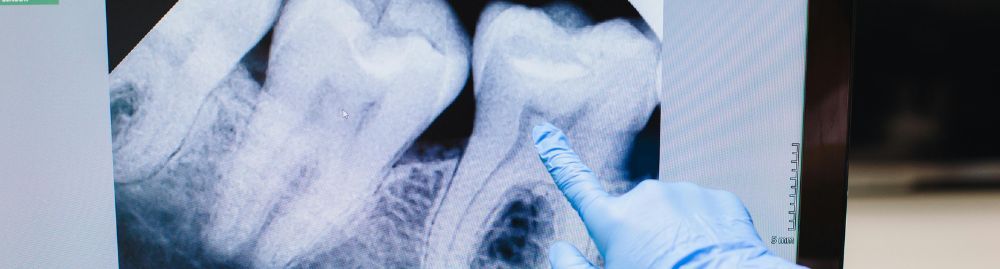 câncer no dente1.jpg