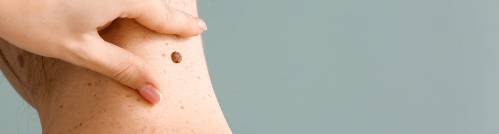 carcinoma tratamento1.jpg