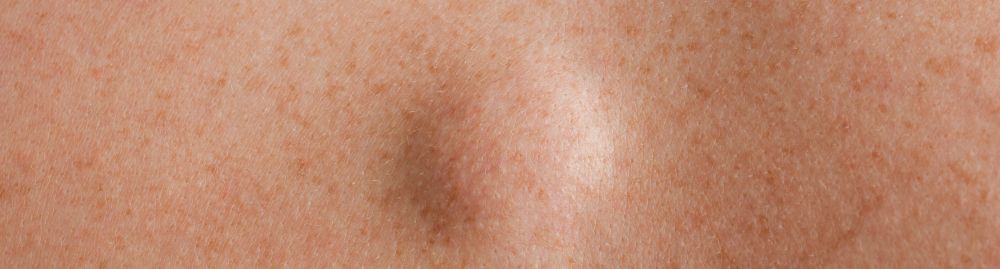 caroço benigno1.jpg