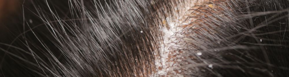 caspa faz o cabelo cair_1.jpg