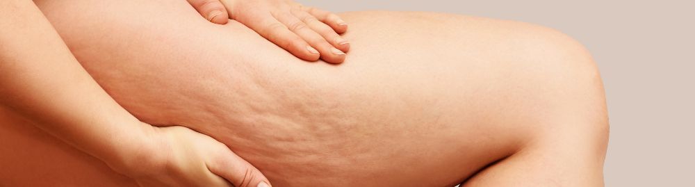 causadores da celulite_1.jpg